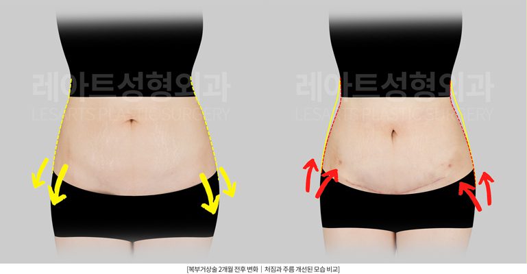 복부거상수술 전후사진 - 레아트 성형외과