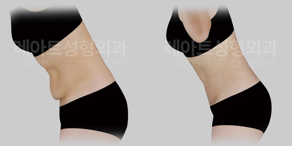 미니 복부거상술 전후사진 - 레아트 성형외과