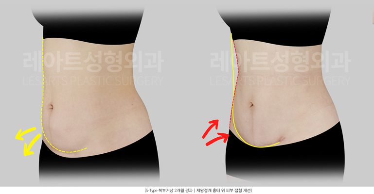 복부거상 전후사진 - 레아트 성형외과