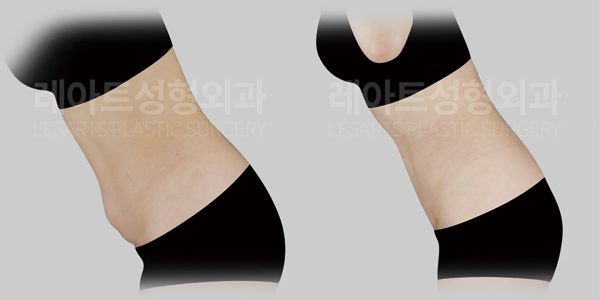 미니복부거상 전후 사진