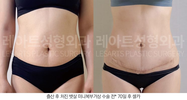 복부거상술 전후사진 레아트 성형외과