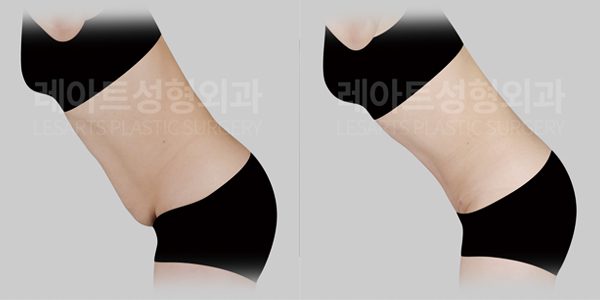 복부거상 전후사진 레아트 성형외과