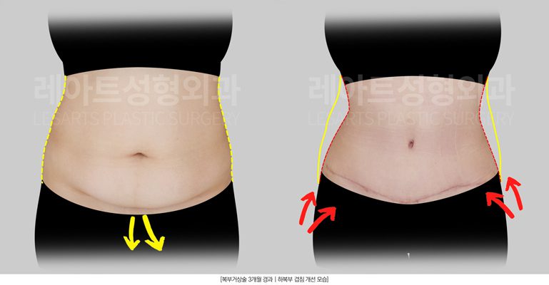 복부거상술 전후사진 레아트 성형외과