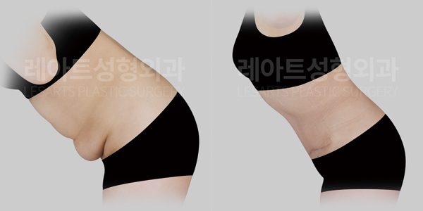 복부거상 수술 전후사진