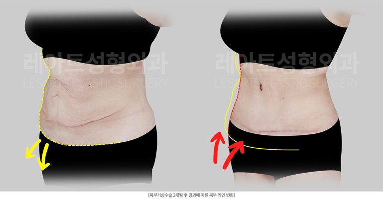 뱃살처짐 복부거상 수술 전후사진 - 레아트 성형외과