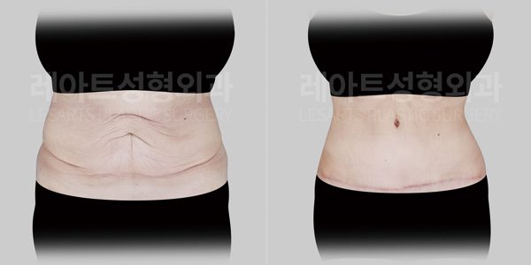 다이어트 이후 복부거상 전후사진