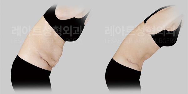 복부거상 전후사진 레아트 성형외과