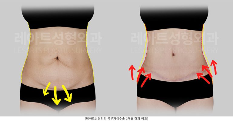 40대 복부거상 전후사진 - 레아트 성형외과