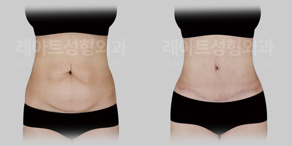 복부거상 실제 전후사진