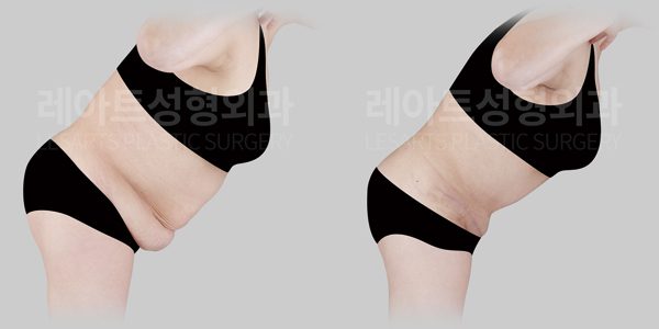 복부거상 수술 전후사진 레아트 성형외과