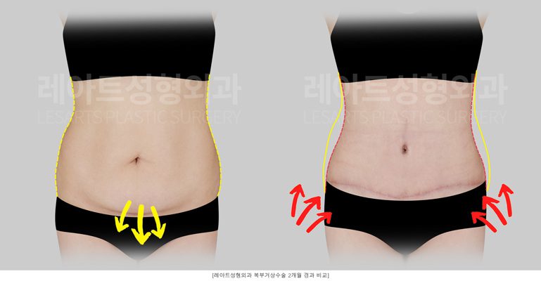 제왕절개 후 복부거상 - 레아트 성형외과