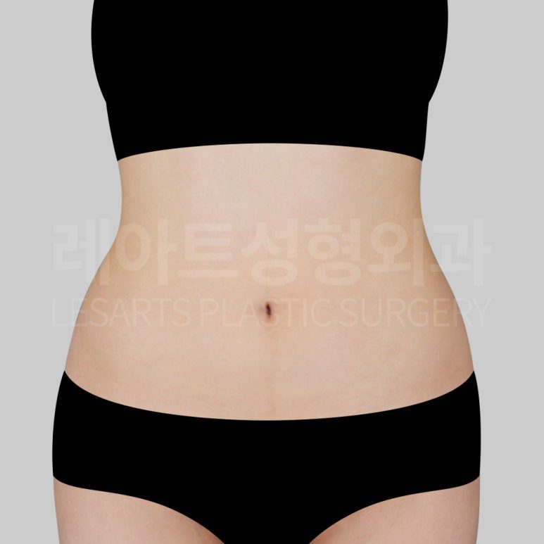 s-abdominal-liposuction-post14-01