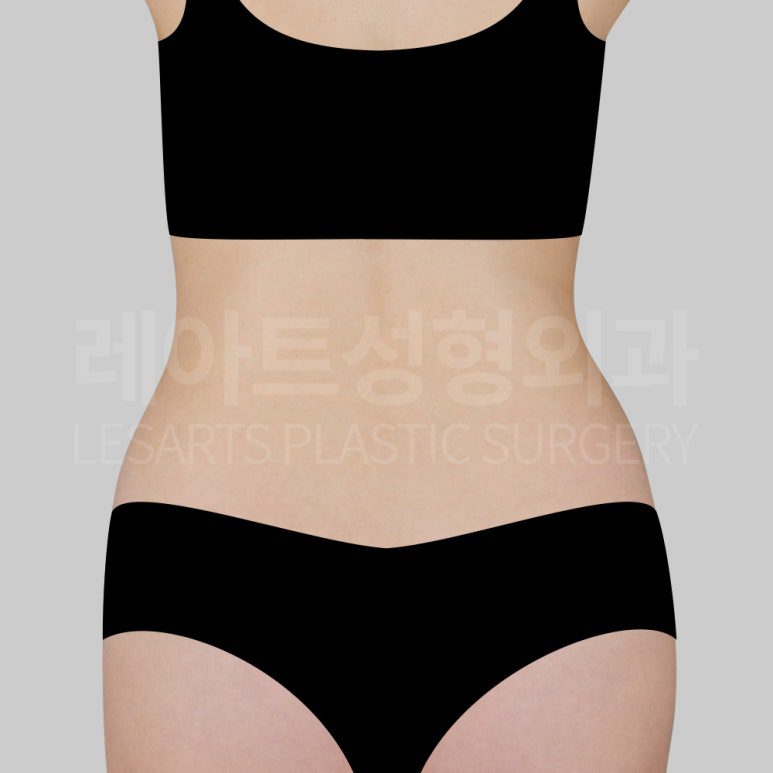s-abdominal-liposuction-post14-02