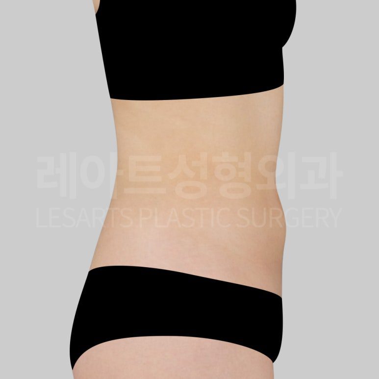 s-abdominal-liposuction-post14-03