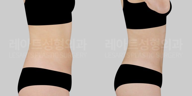복부지방흡입 전후사진 사례 - 레아트 성형외과