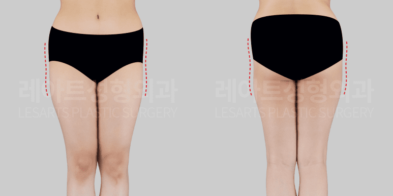 힙딥 지방이식 전후사진 - 레아트 성형외과