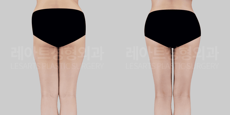 힙딥 지방이식, 허벅지 지방흡입 전후사진