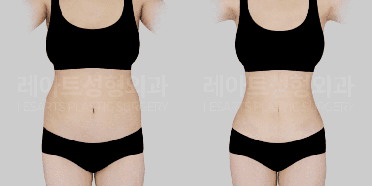 복부 지방흡입 전후 사진 - 레아트 성형외과