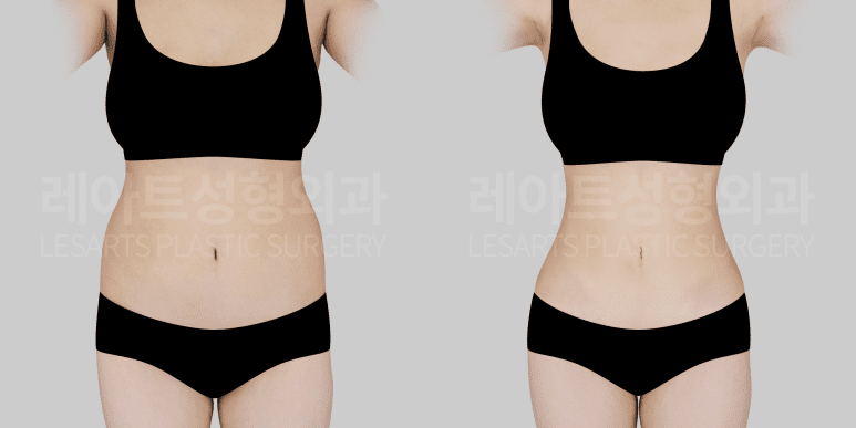 복부 지방흡입 전후 사진 - 레아트 성형외과