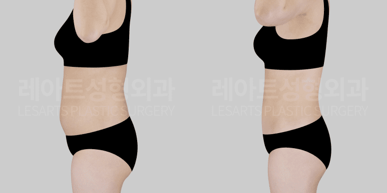 복부지방흡입 전후사진- 옆모습