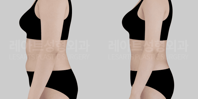 복부 지방흡입 후 옆모습