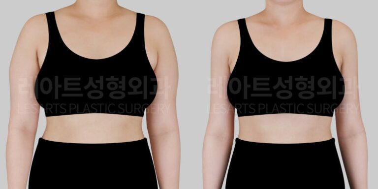 팔 지방흡입 전후사진 레아트 성형외과