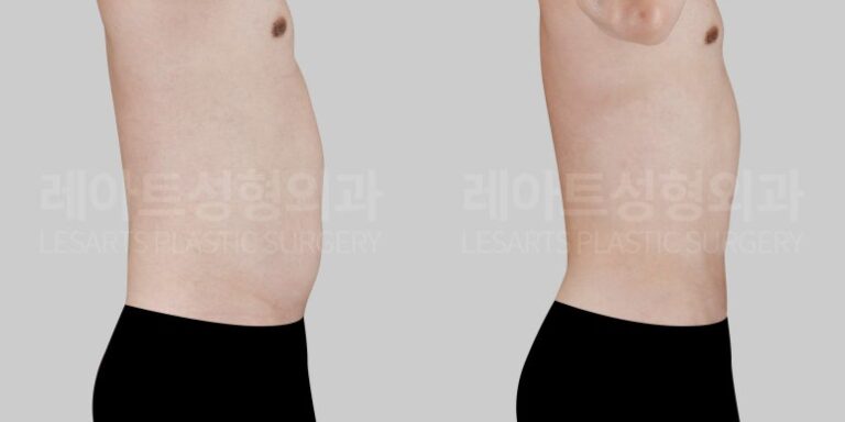 남자 복부 지방흡입 전후사진
