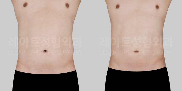 남성 복부 지방흡입 전후사진 - 레아트 성형외과