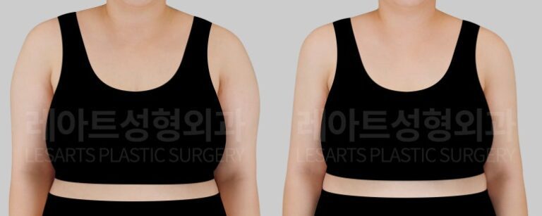 팔 지방흡입 전후사진