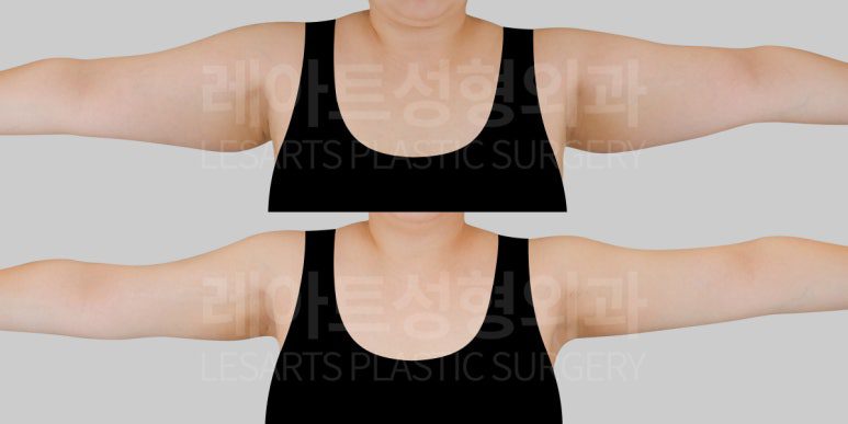 저고리살 지방흡입 전후사진