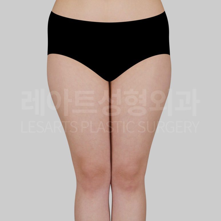 s-thigh-liposuction-post13-01