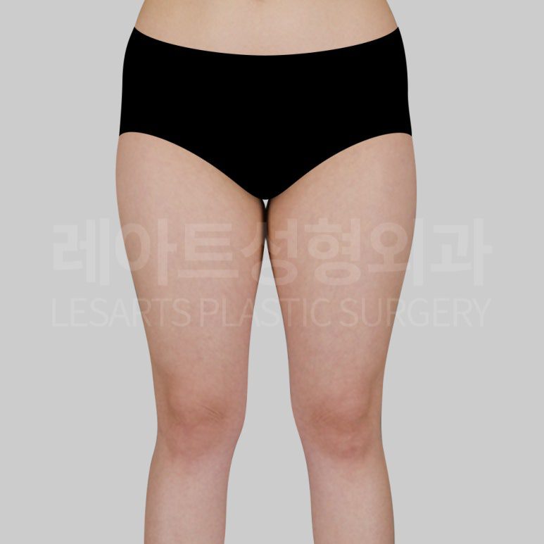 s-thigh-liposuction-post13-02