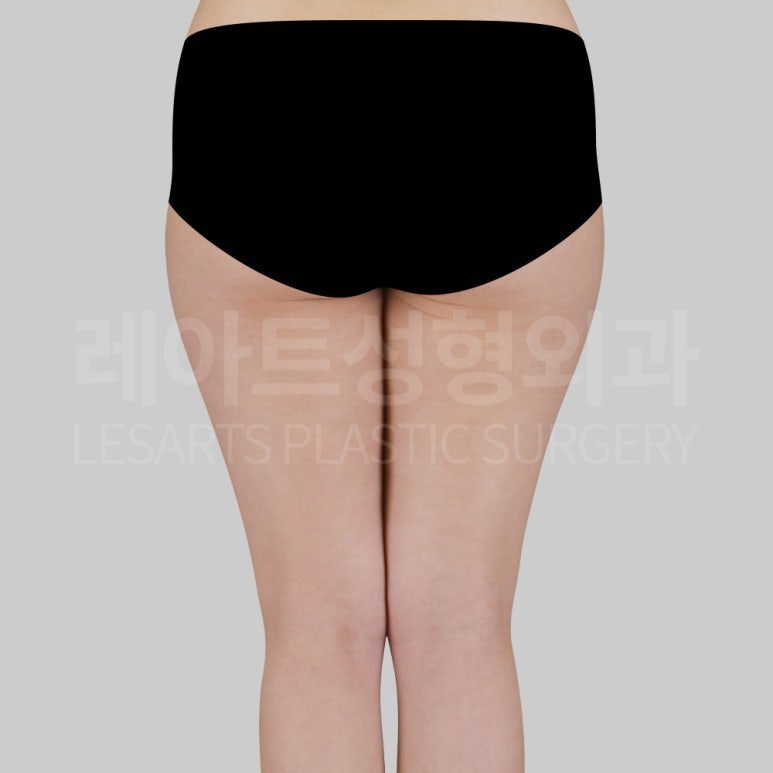 s-thigh-liposuction-post13-03