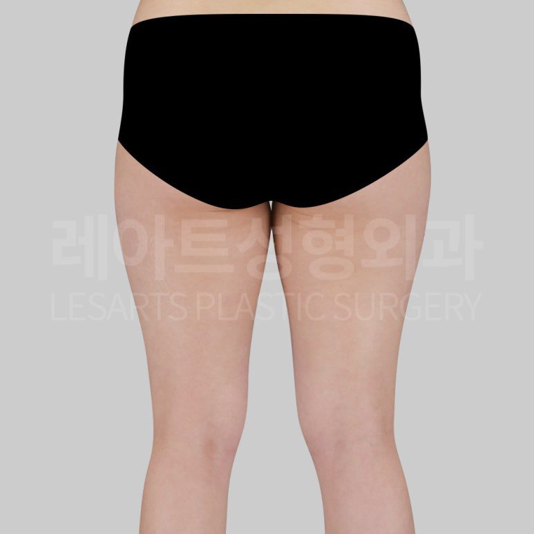 s-thigh-liposuction-post13-04
