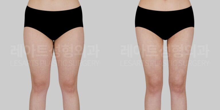 허벅지 지방흡입 전후사진