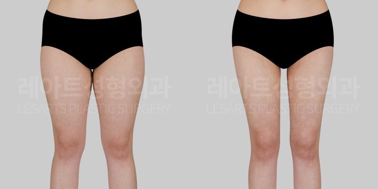 허벅지 지방흡입 전후사진