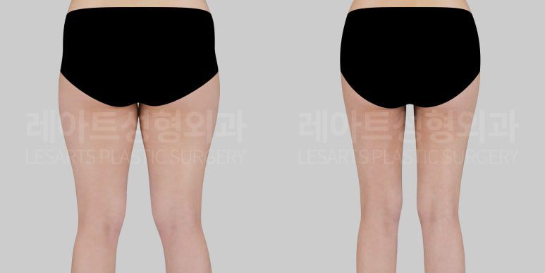 허벅지 지방흡입 전후 사례 - 레아트 성형외과