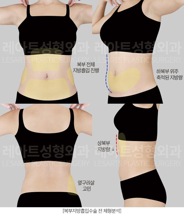 복부 지방흡입 전후사진 수술 플랜