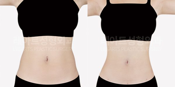복부 지방흡입 전후사진