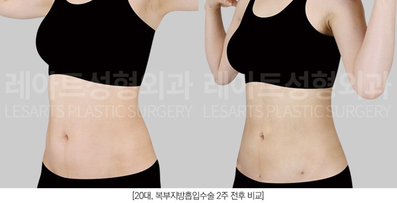 뱃살 지방흡입 전후사진