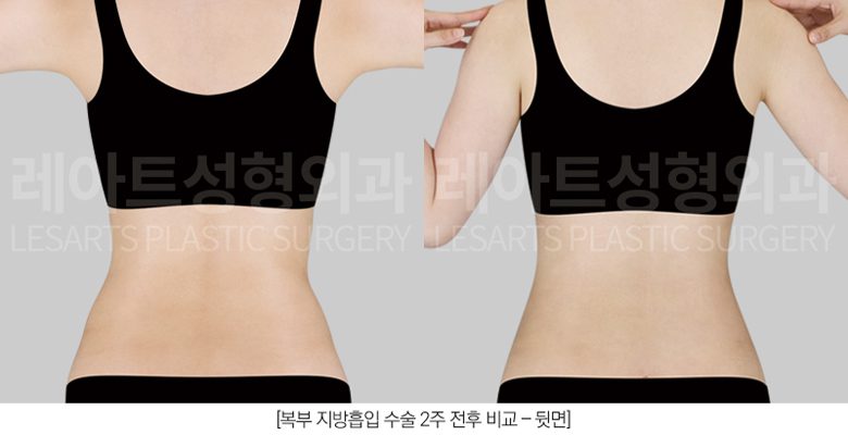 옆구리 지방흡입 전후사진