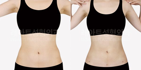 복부 지방흡입 레아트 성형괴과 전후사진