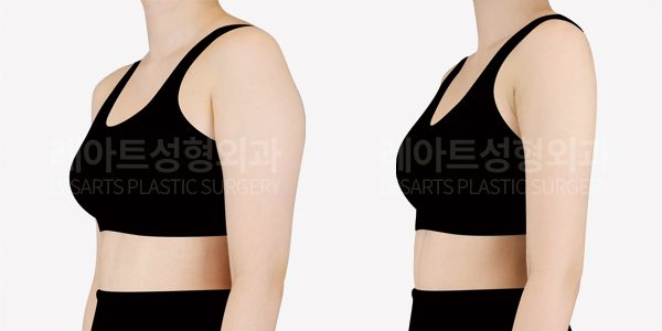 팔 지방흡입 전후사진 레아트 성형외과