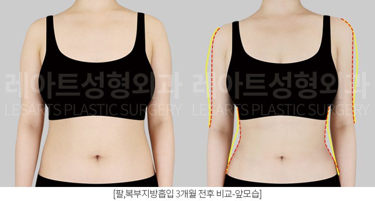 팔지흡 후 직각 어깨