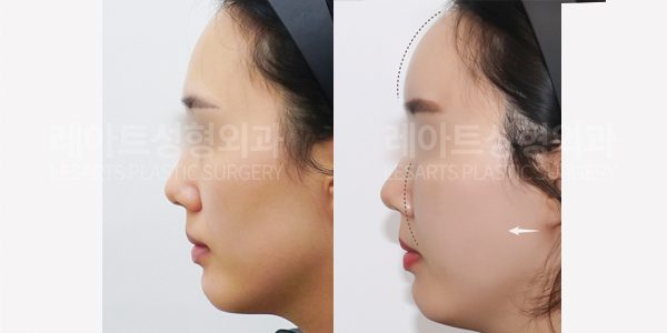 얼굴 지방이식 전후사진 레아트 성형외과