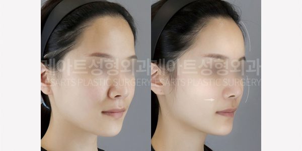얼굴 지방흡입 전후사진 레아트 성형외과