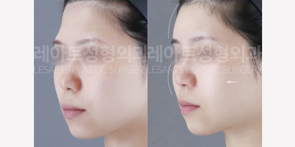 얼굴 지방이식 전후사진
