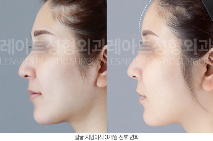 이마 지방이식 전후사진