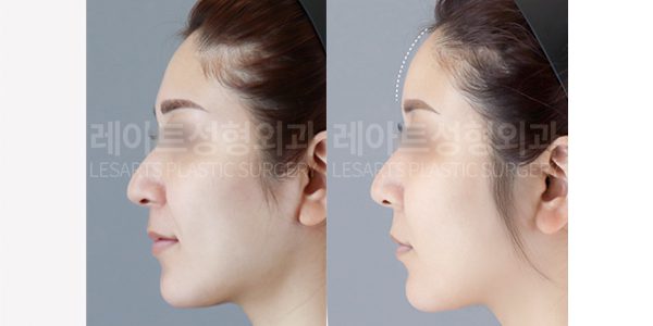 얼굴 지방이식 레아트 성형외과