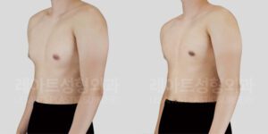 여유증 그레이드2-a 여유증 수술 전후 사진